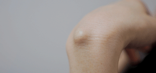 粉瘤・脂肪腫手術